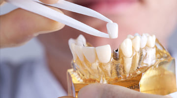 Имплантация <br>и протезирование зубов